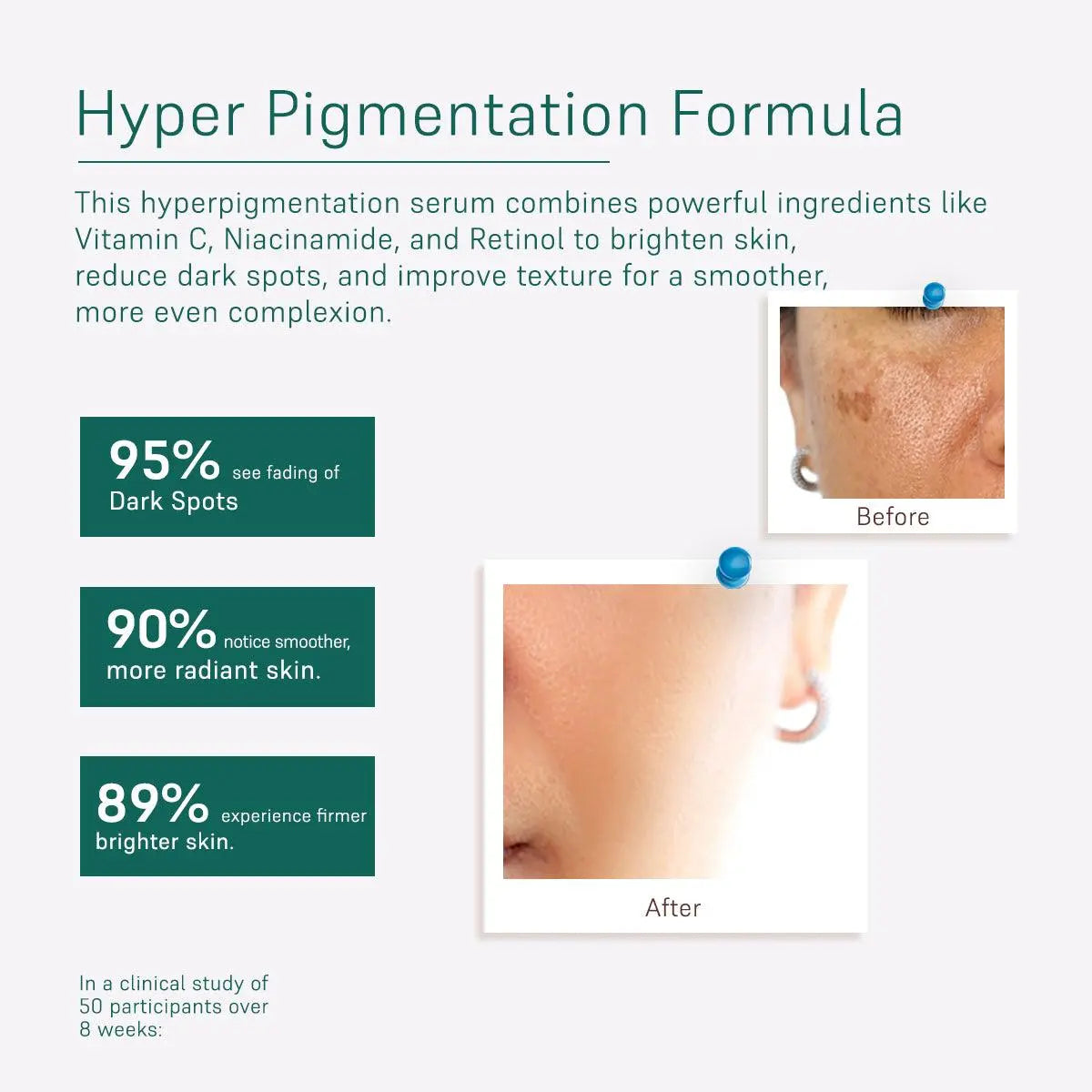 Face Serum For Hyper Pigmentation - For Her - Coal Clean Beauty